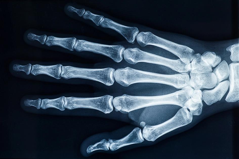 Röntgad Hand