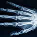 Röntgad Hand