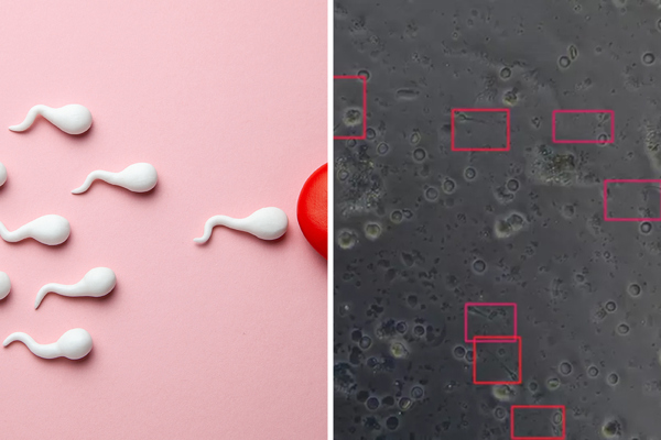 L’intelligenza artificiale trova lo sperma negli uomini sterili